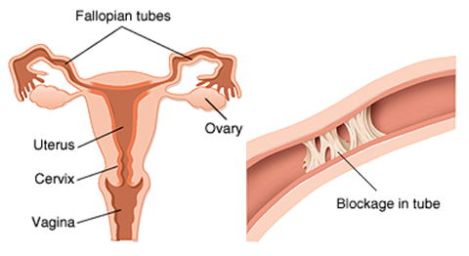 Blocked Fallopian Tube