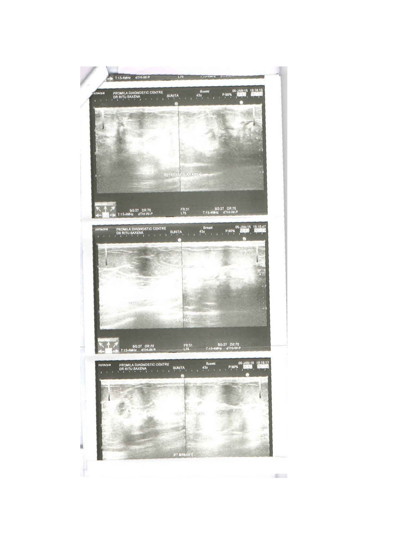 Oligospermia Before Treatment 2