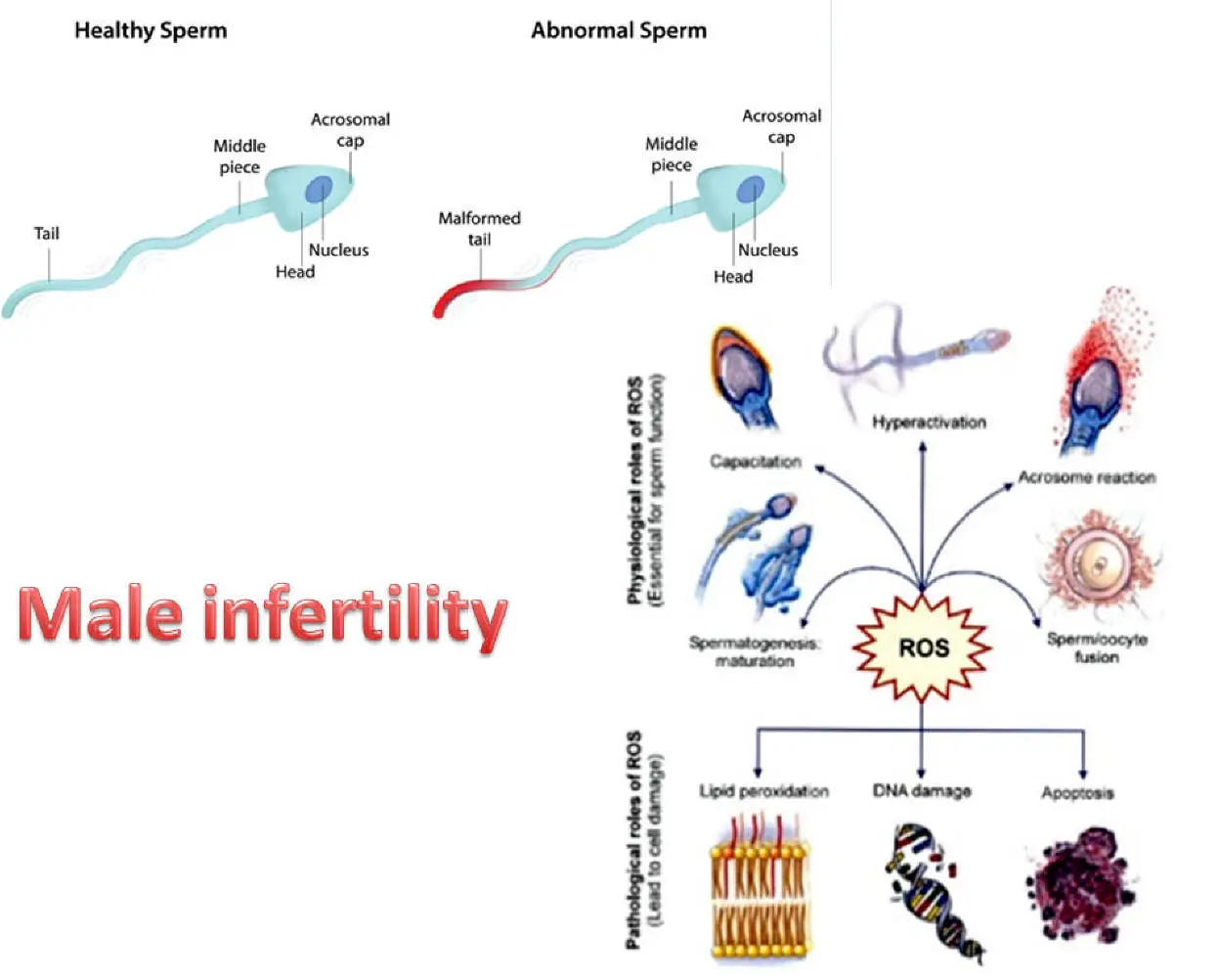 Semen Analysis - Zero Sperm