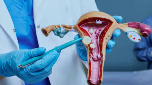 Fibroids Homeopathic Treatment