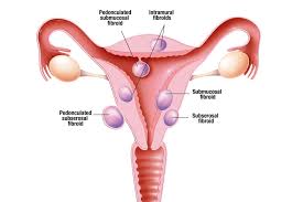Types of Fibroids