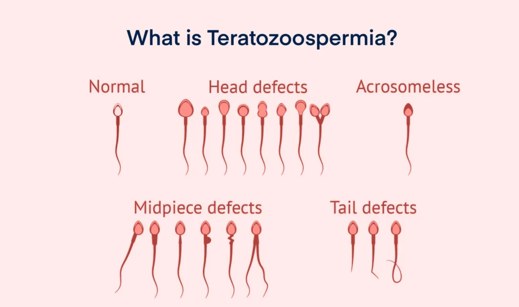 Oligoasthenoteratozoospermia