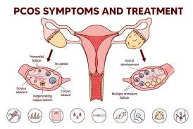 Normal Ovary vs PCOS Ovary
