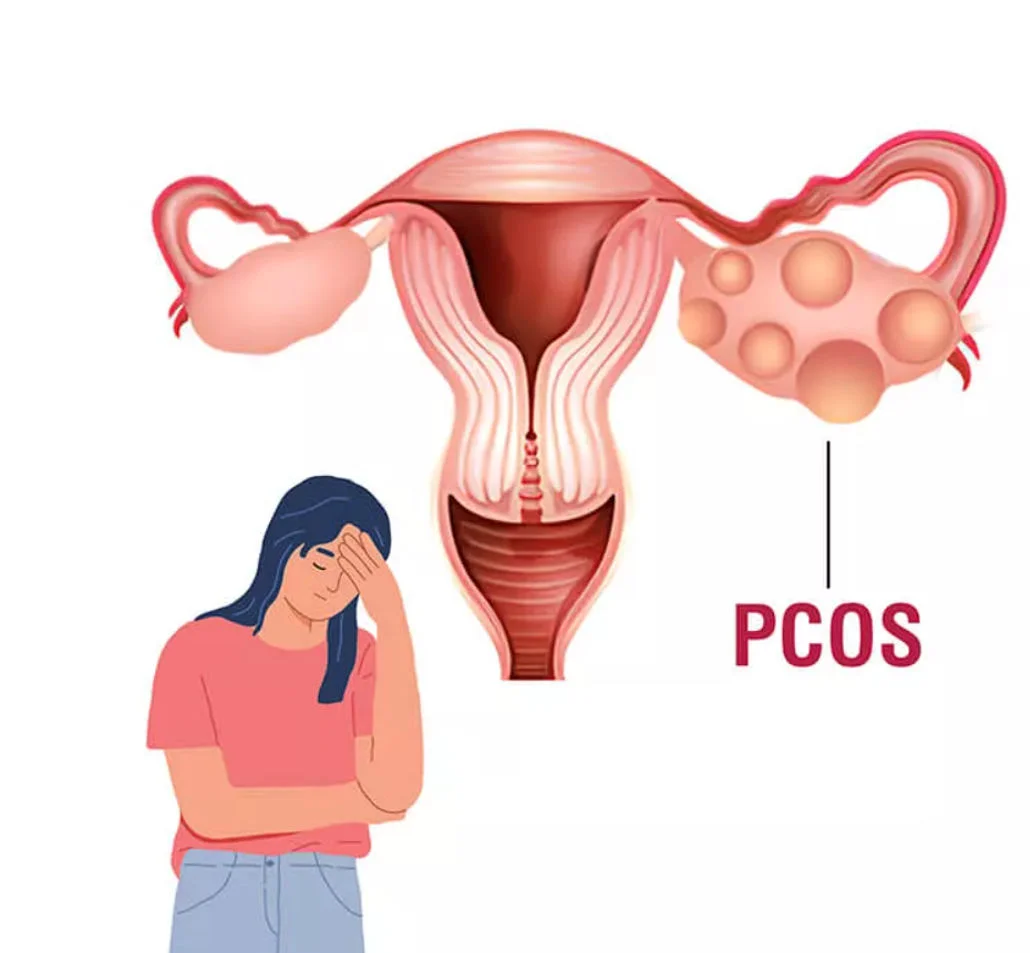 PCOS Ovary