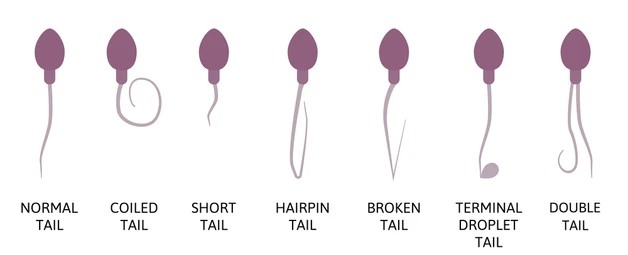 Types of Sperm Abnormalities