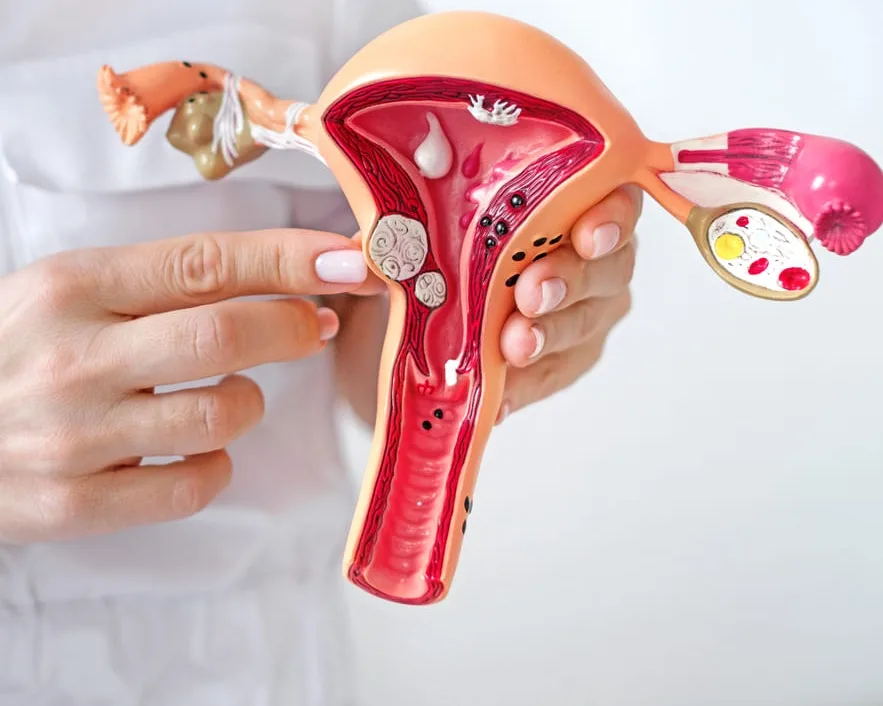 Uterine Fibroids